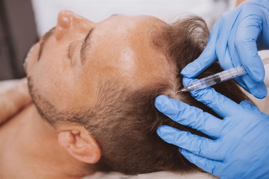 PRP for Male Hair Loss 