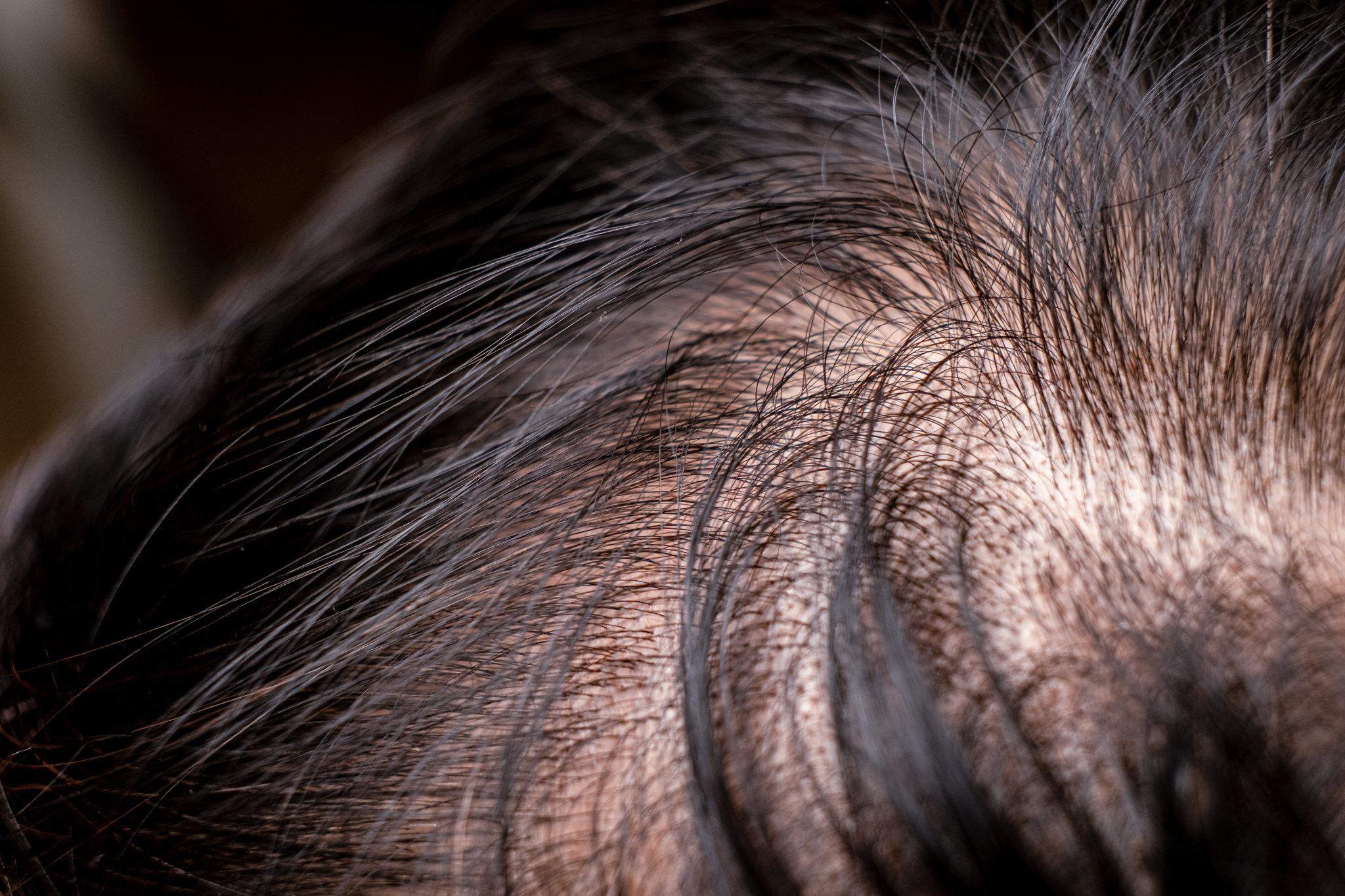 PRP For Hair Restoration: A Successful Medical Treatment for Hair Loss