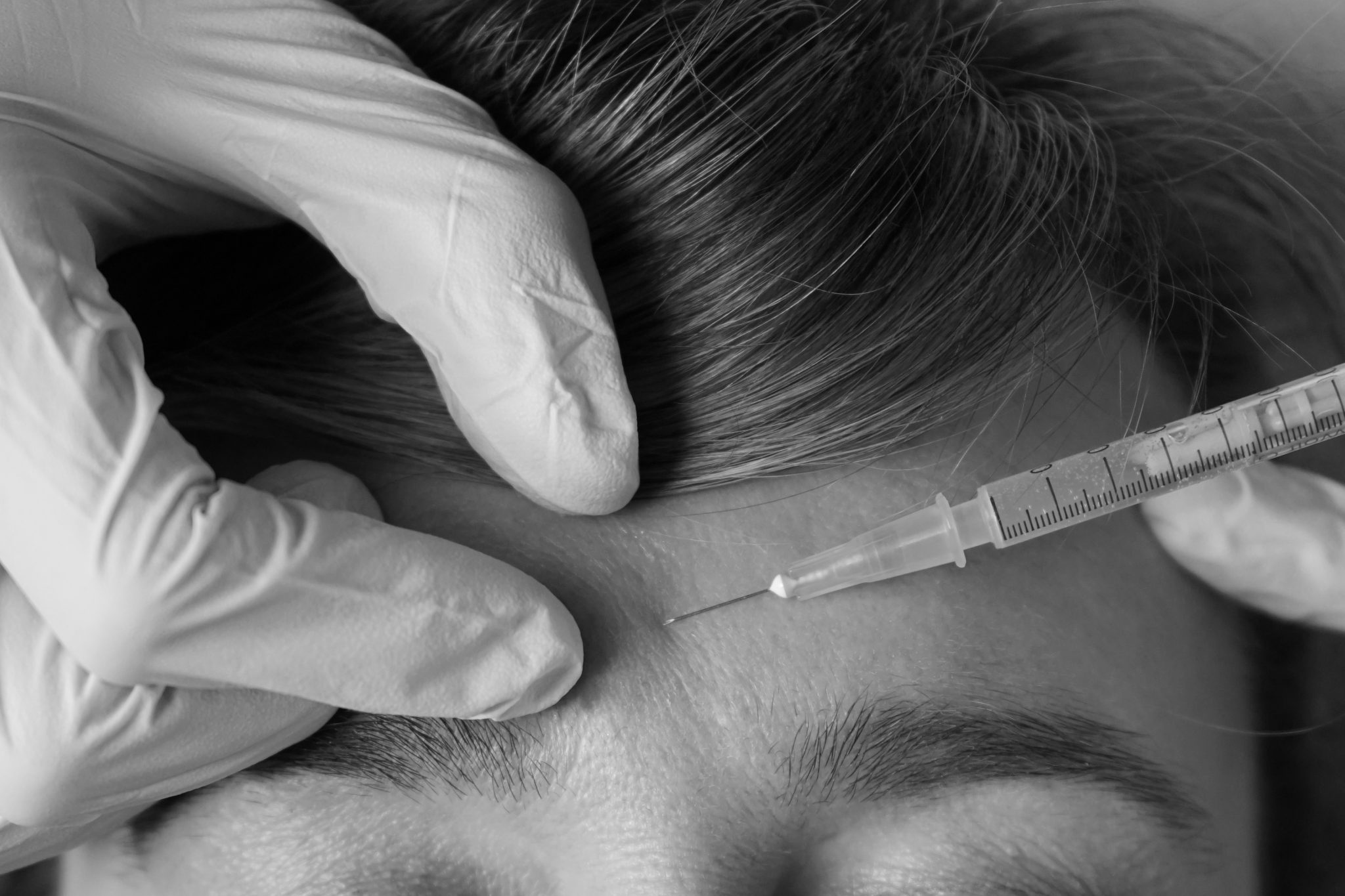 What You Need to Know About Botox Injections for Facial Wrinkles Smoothing