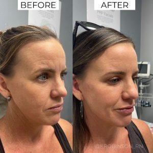 Before and After Botox