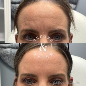 Before and After Wrinkles