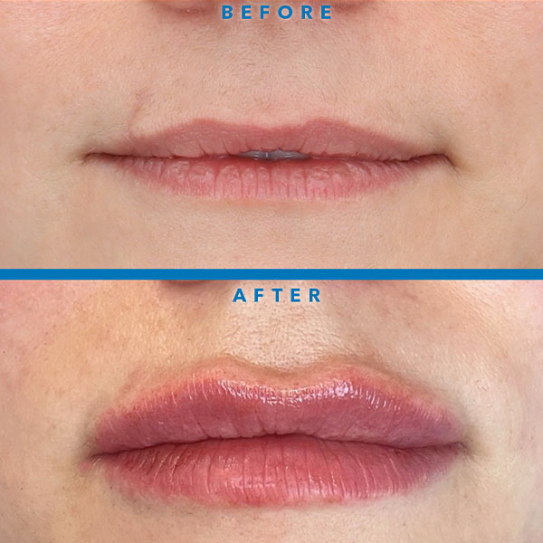 RHA dermal fillers in Virginia Beach before and after