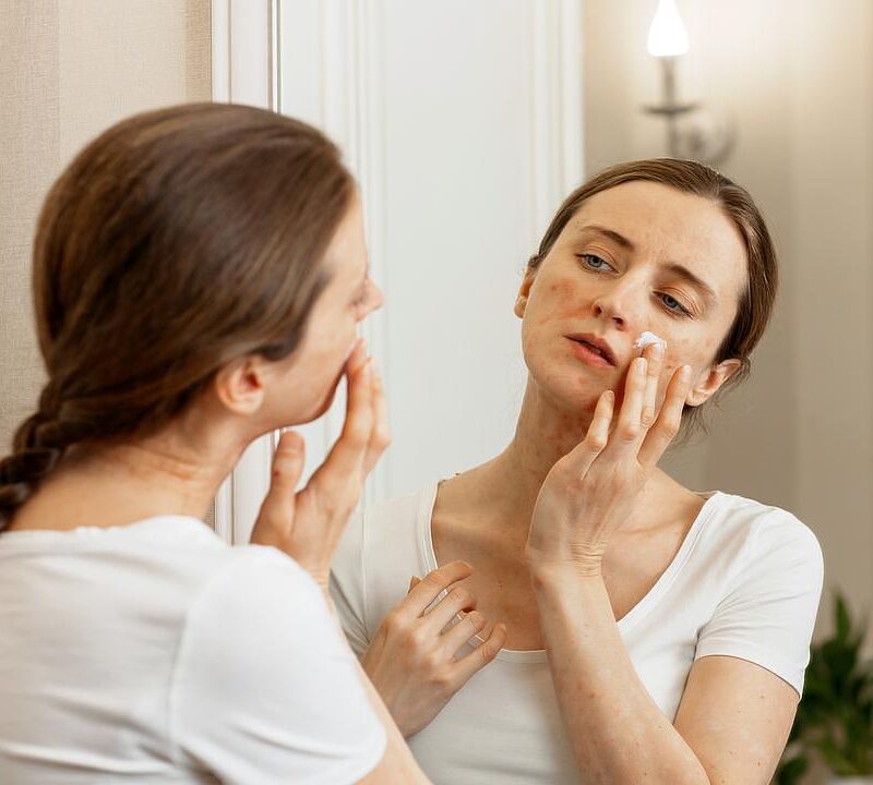 Woman looking in a mirror applying a cream to her rosacea