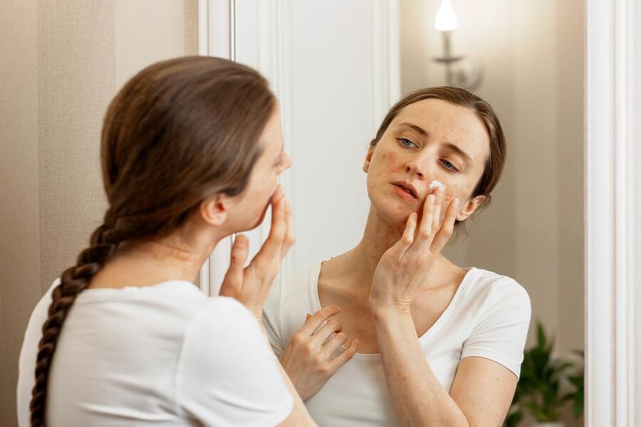 Woman looking in a mirror applying a cream to her rosacea